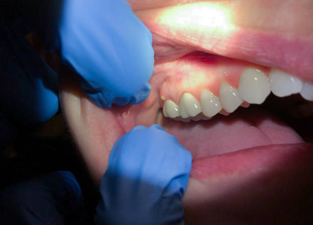 Best Tooth Infection Emergency Dentist  in Union City, OH